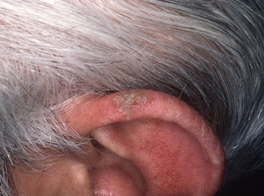 Hyperkeratotic lesion on the left ear *