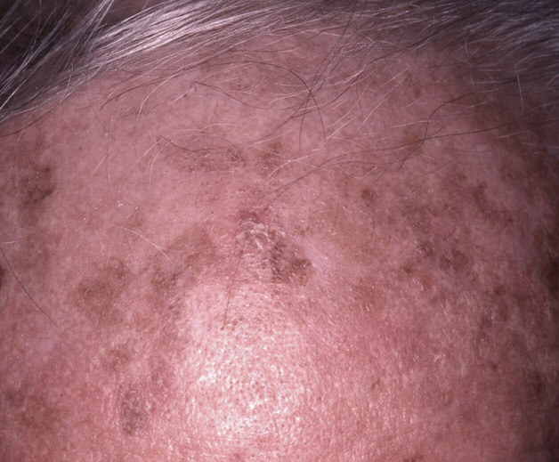 Actinic keratosis, multiple lesions