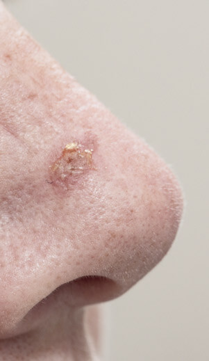 Actinic keratosis on the nose