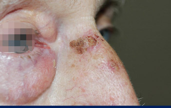 Lesion with actinic keratosis ulceration