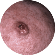 Invasive squamous cell carcinoma